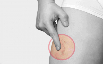 Tratamiento para las varices