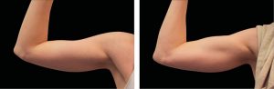 eliminar la grasa con emsculpt